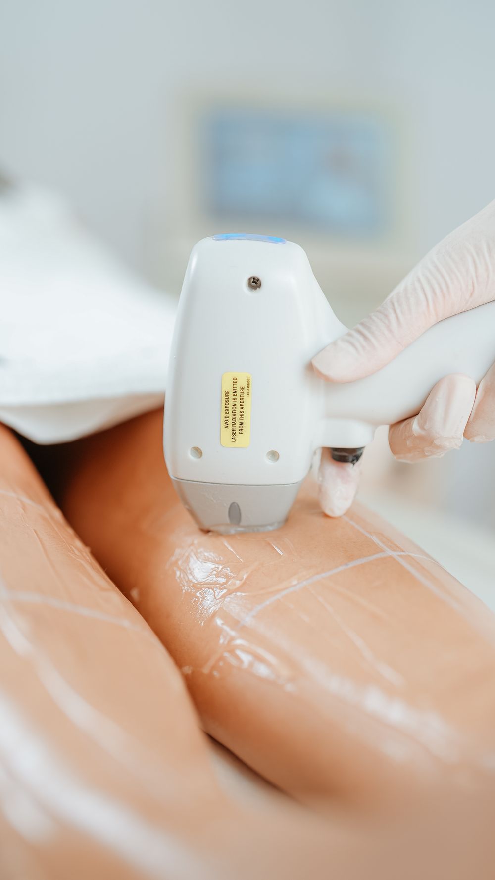 Épilation laser jambes
